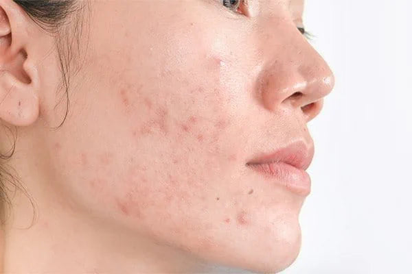 Hyperpigmentation, you little DIVA you!