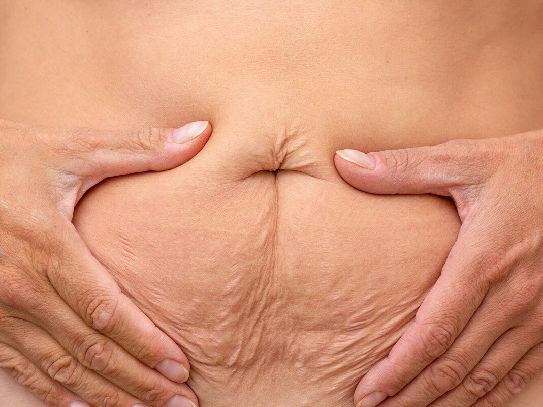 Losing Weight While Keeping Your Skin Firm